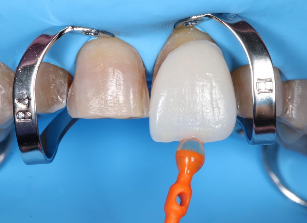 Curso de estética y prótesis dental
